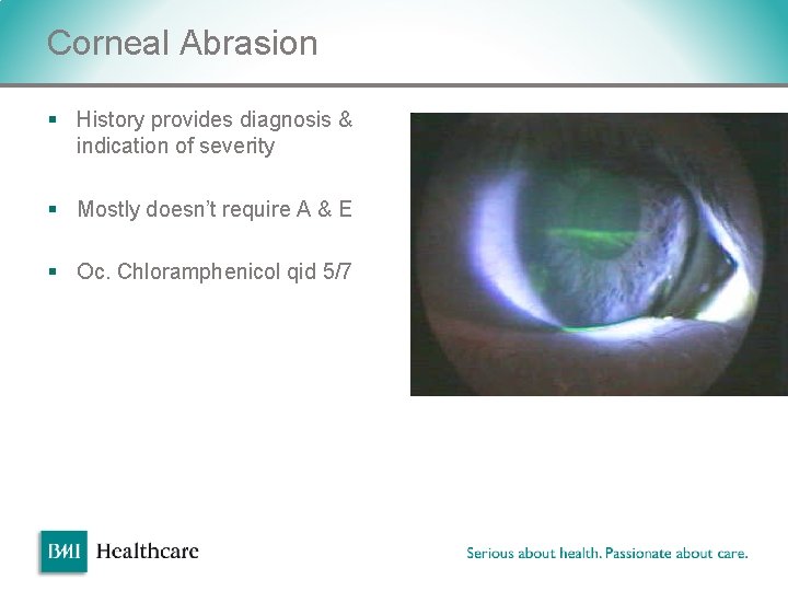 Corneal Abrasion § History provides diagnosis & indication of severity § Mostly doesn’t require Corneal Abrasion § History provides diagnosis & indication of severity § Mostly doesn’t require