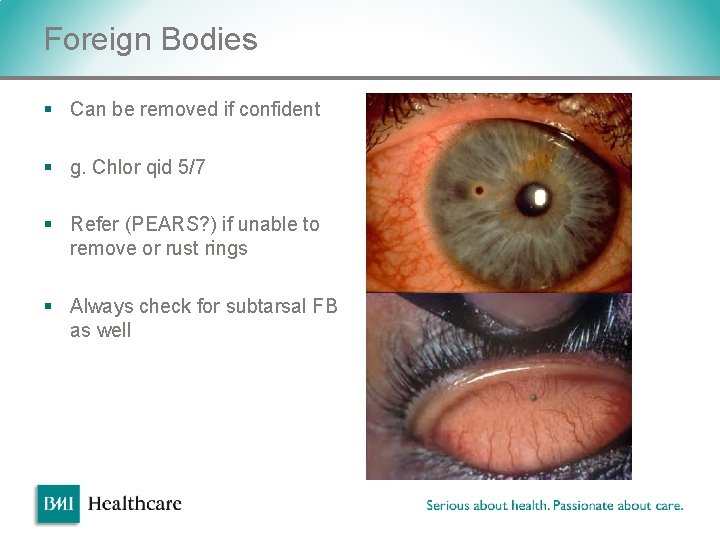 Foreign Bodies § Can be removed if confident § g. Chlor qid 5/7 § Foreign Bodies § Can be removed if confident § g. Chlor qid 5/7 §