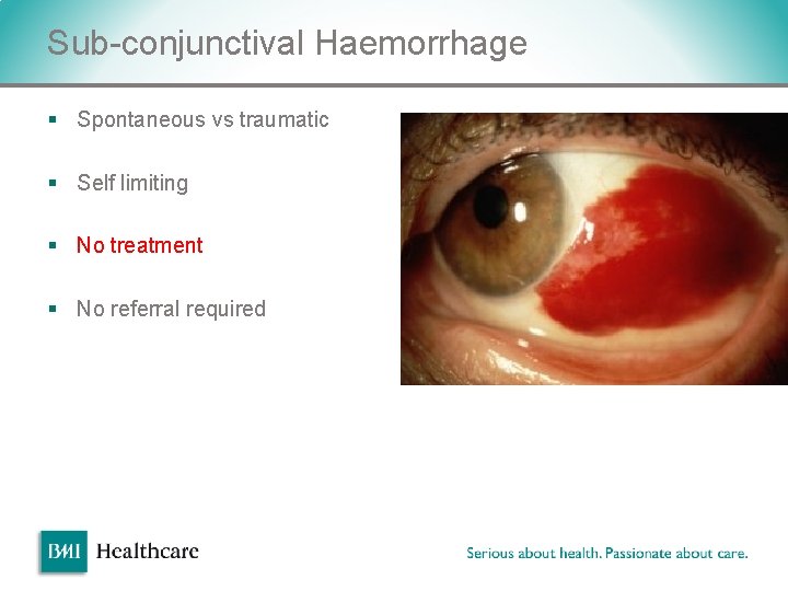 Sub-conjunctival Haemorrhage § Spontaneous vs traumatic § Self limiting § No treatment § No Sub-conjunctival Haemorrhage § Spontaneous vs traumatic § Self limiting § No treatment § No