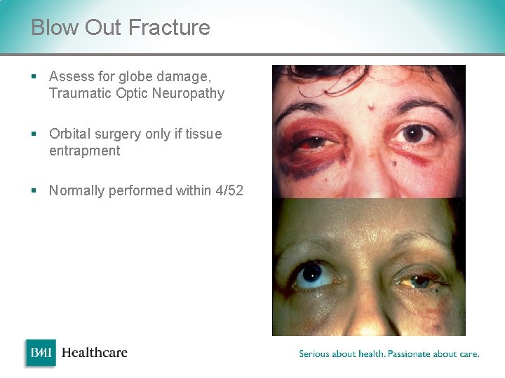 Blow Out Fracture § Assess for globe damage, Traumatic Optic Neuropathy § Orbital surgery Blow Out Fracture § Assess for globe damage, Traumatic Optic Neuropathy § Orbital surgery