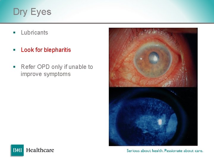 Dry Eyes § Lubricants § Look for blepharitis § Refer OPD only if unable Dry Eyes § Lubricants § Look for blepharitis § Refer OPD only if unable