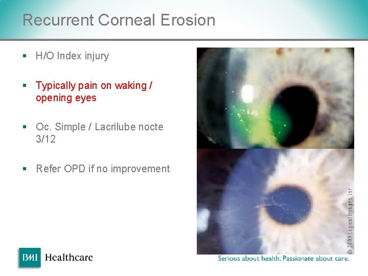 Recurrent Corneal Erosion § H/O Index injury § Typically pain on waking / opening Recurrent Corneal Erosion § H/O Index injury § Typically pain on waking / opening
