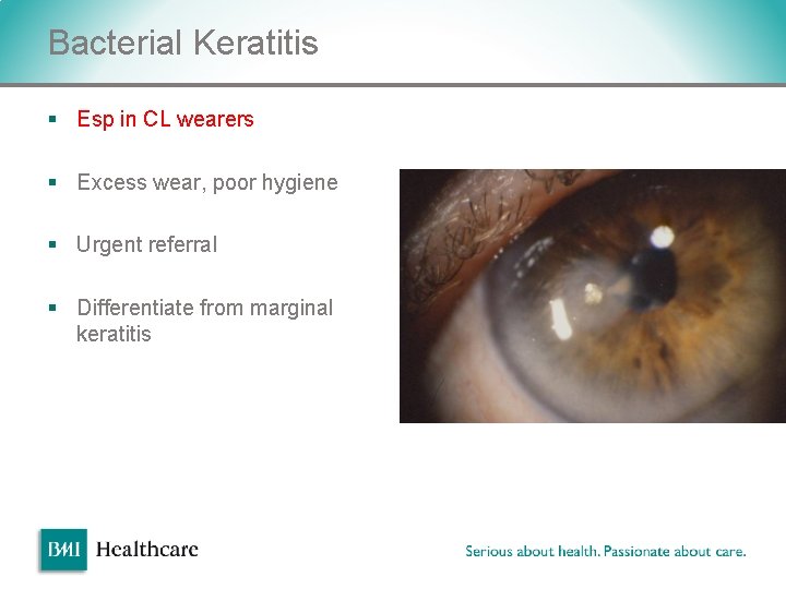 Bacterial Keratitis § Esp in CL wearers § Excess wear, poor hygiene § Urgent Bacterial Keratitis § Esp in CL wearers § Excess wear, poor hygiene § Urgent