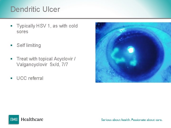 Dendritic Ulcer § Typically HSV 1, as with cold sores § Self limiting § Dendritic Ulcer § Typically HSV 1, as with cold sores § Self limiting §