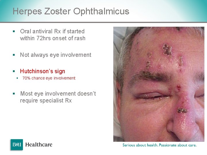 Herpes Zoster Ophthalmicus § Oral antiviral Rx if started within 72 hrs onset of Herpes Zoster Ophthalmicus § Oral antiviral Rx if started within 72 hrs onset of