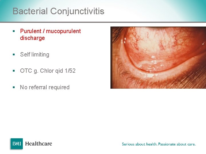 Bacterial Conjunctivitis § Purulent / mucopurulent discharge § Self limiting § OTC g. Chlor Bacterial Conjunctivitis § Purulent / mucopurulent discharge § Self limiting § OTC g. Chlor
