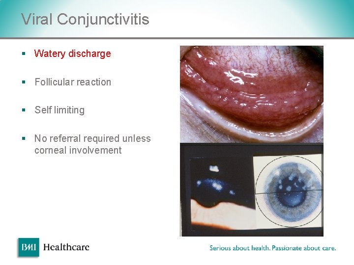 Viral Conjunctivitis § Watery discharge § Follicular reaction § Self limiting § No referral Viral Conjunctivitis § Watery discharge § Follicular reaction § Self limiting § No referral