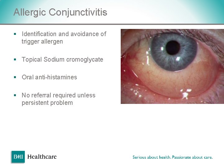 Allergic Conjunctivitis § Identification and avoidance of trigger allergen § Topical Sodium cromoglycate § Allergic Conjunctivitis § Identification and avoidance of trigger allergen § Topical Sodium cromoglycate §
