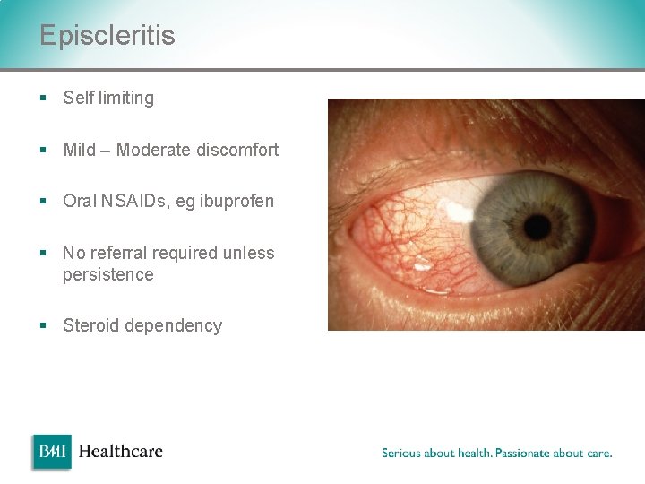 Episcleritis § Self limiting § Mild – Moderate discomfort § Oral NSAIDs, eg ibuprofen Episcleritis § Self limiting § Mild – Moderate discomfort § Oral NSAIDs, eg ibuprofen