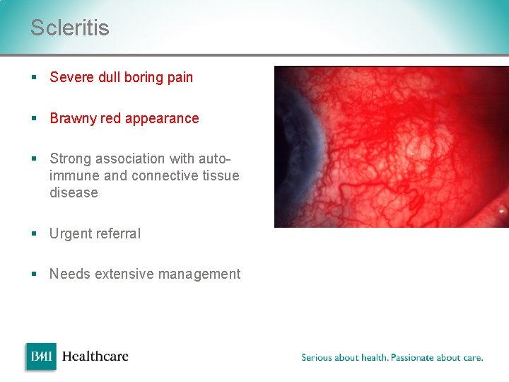 Scleritis § Severe dull boring pain § Brawny red appearance § Strong association with Scleritis § Severe dull boring pain § Brawny red appearance § Strong association with