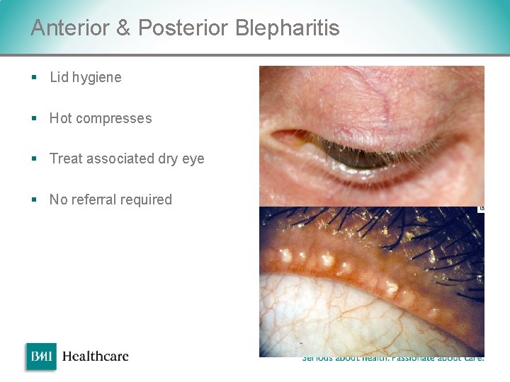 Anterior & Posterior Blepharitis § Lid hygiene § Hot compresses § Treat associated dry Anterior & Posterior Blepharitis § Lid hygiene § Hot compresses § Treat associated dry