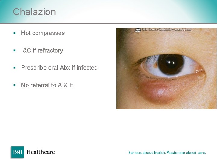 Chalazion § Hot compresses § I&C if refractory § Prescribe oral Abx if infected Chalazion § Hot compresses § I&C if refractory § Prescribe oral Abx if infected