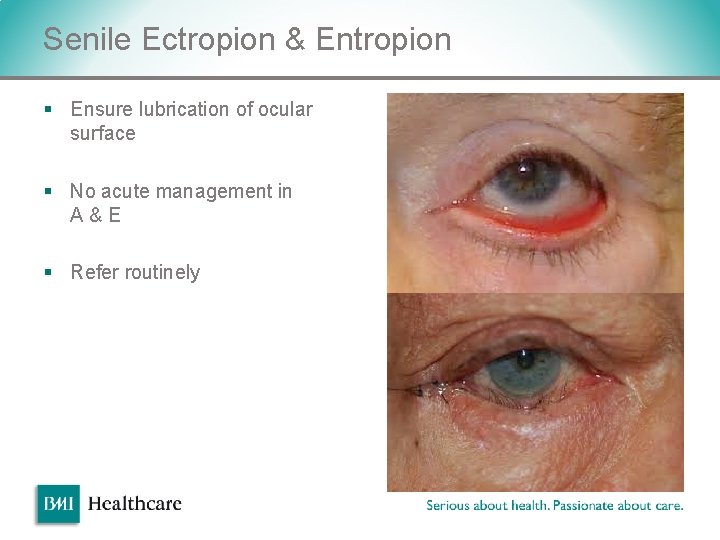 Senile Ectropion & Entropion § Ensure lubrication of ocular surface § No acute management Senile Ectropion & Entropion § Ensure lubrication of ocular surface § No acute management