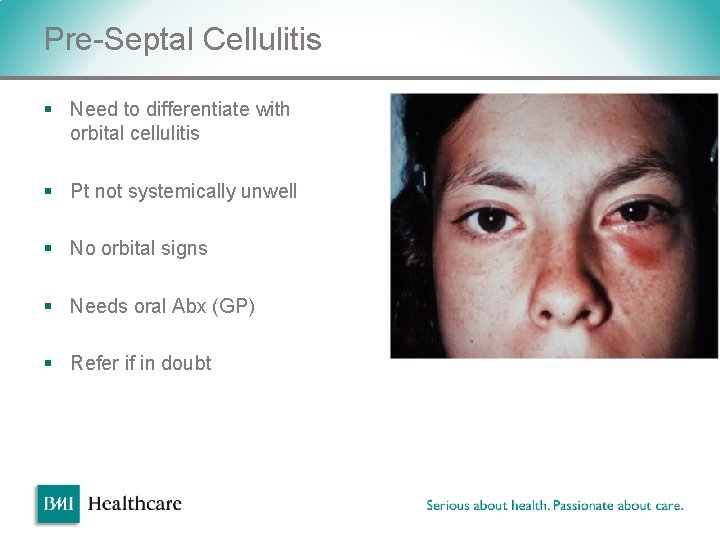 Pre-Septal Cellulitis § Need to differentiate with orbital cellulitis § Pt not systemically unwell Pre-Septal Cellulitis § Need to differentiate with orbital cellulitis § Pt not systemically unwell