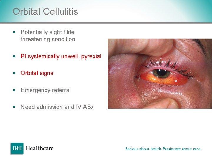 Orbital Cellulitis § Potentially sight / life threatening condition § Pt systemically unwell, pyrexial Orbital Cellulitis § Potentially sight / life threatening condition § Pt systemically unwell, pyrexial