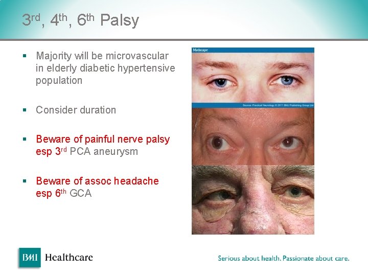 3 rd, 4 th, 6 th Palsy § Majority will be microvascular in elderly 3 rd, 4 th, 6 th Palsy § Majority will be microvascular in elderly