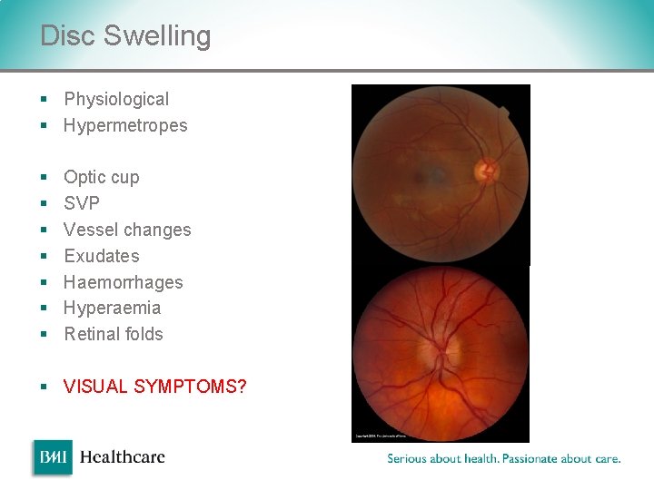 Disc Swelling § Physiological § Hypermetropes § § § § Optic cup SVP Vessel Disc Swelling § Physiological § Hypermetropes § § § § Optic cup SVP Vessel