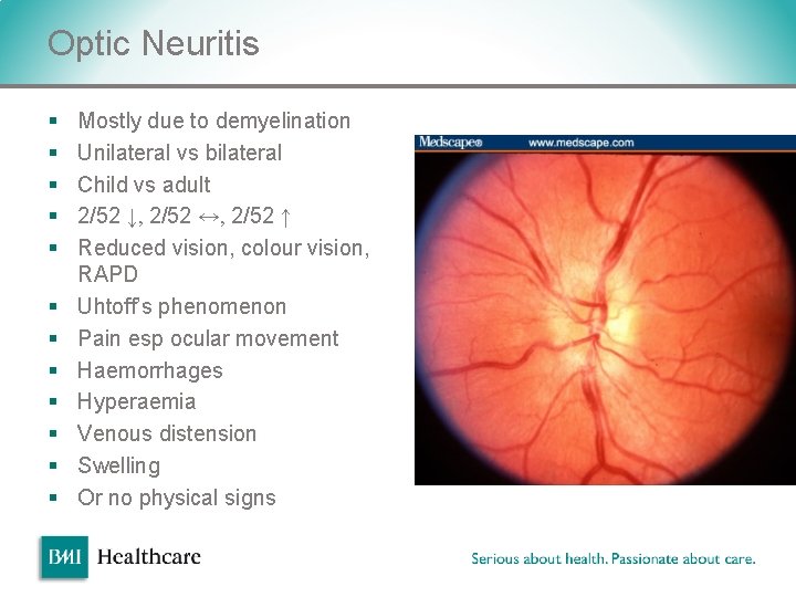 Optic Neuritis § § § Mostly due to demyelination Unilateral vs bilateral Child vs Optic Neuritis § § § Mostly due to demyelination Unilateral vs bilateral Child vs