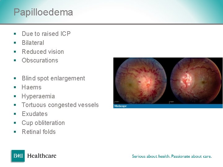 Papilloedema § § Due to raised ICP Bilateral Reduced vision Obscurations § § § Papilloedema § § Due to raised ICP Bilateral Reduced vision Obscurations § § §