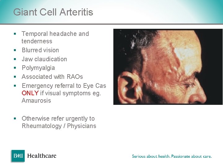 Giant Cell Arteritis § Temporal headache and tenderness § Blurred vision § Jaw claudication Giant Cell Arteritis § Temporal headache and tenderness § Blurred vision § Jaw claudication
