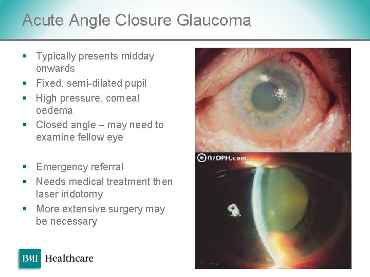 Acute Angle Closure Glaucoma § Typically presents midday onwards § Fixed, semi-dilated pupil § Acute Angle Closure Glaucoma § Typically presents midday onwards § Fixed, semi-dilated pupil §