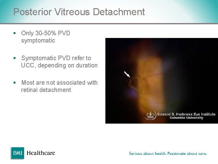Posterior Vitreous Detachment § Only 30 -50% PVD symptomatic § Symptomatic PVD refer to Posterior Vitreous Detachment § Only 30 -50% PVD symptomatic § Symptomatic PVD refer to