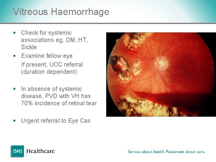 Vitreous Haemorrhage § Check for systemic associations eg. DM, HT, Sickle § Examine fellow Vitreous Haemorrhage § Check for systemic associations eg. DM, HT, Sickle § Examine fellow