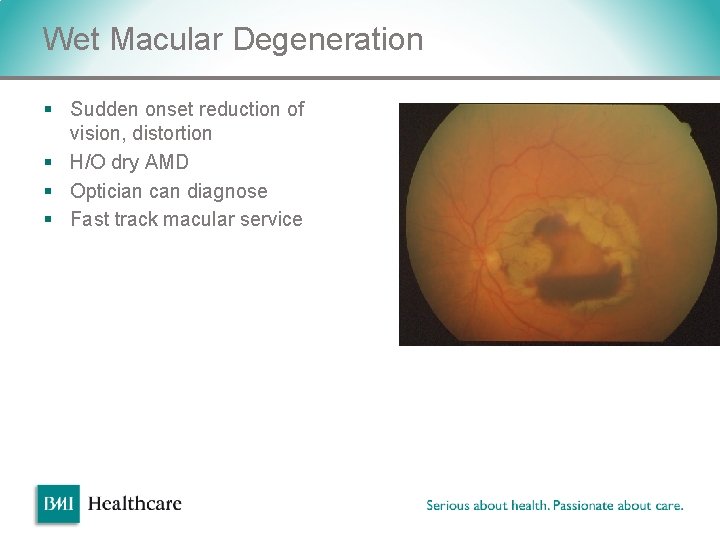 Wet Macular Degeneration § Sudden onset reduction of vision, distortion § H/O dry AMD Wet Macular Degeneration § Sudden onset reduction of vision, distortion § H/O dry AMD