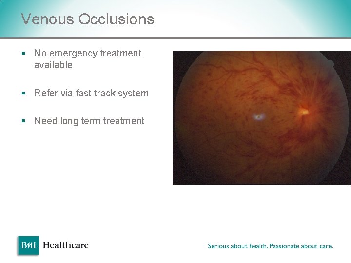 Venous Occlusions § No emergency treatment available § Refer via fast track system § Venous Occlusions § No emergency treatment available § Refer via fast track system §