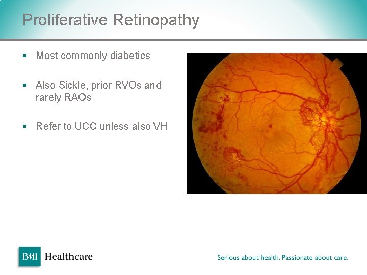 Proliferative Retinopathy § Most commonly diabetics § Also Sickle, prior RVOs and rarely RAOs Proliferative Retinopathy § Most commonly diabetics § Also Sickle, prior RVOs and rarely RAOs