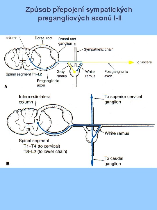 Způsob přepojení sympatických pregangliových axonů I-II 