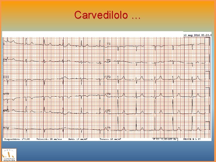 Carvedilolo … 