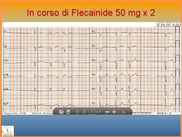 In corso di Flecainide 50 mg x 2 