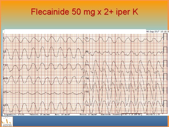 Flecainide 50 mg x 2+ iper K 