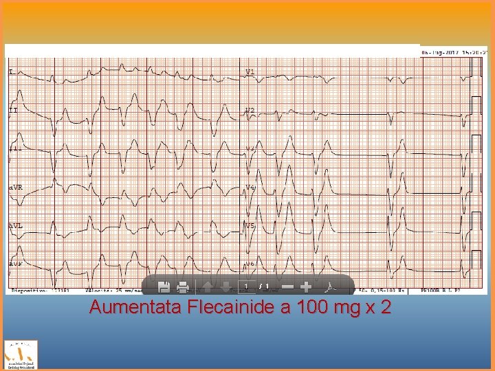 Aumentata Flecainide a 100 mg x 2 