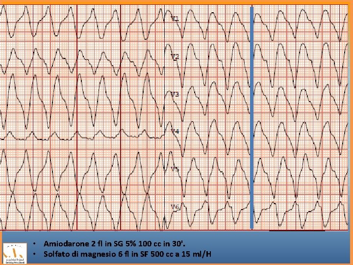  • Amiodarone 2 fl in SG 5% 100 cc in 30'. • Solfato