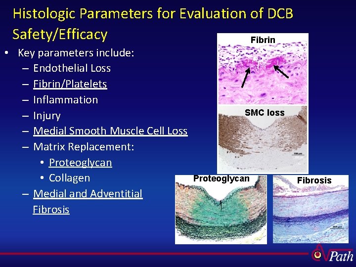 Histologic Parameters for Evaluation of DCB Safety/Efficacy Fibrin • Key parameters include: – Endothelial