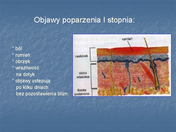 Objawy poparzenia I stopnia: * ból * rumień * obrzęk * wrażliwość na dotyk