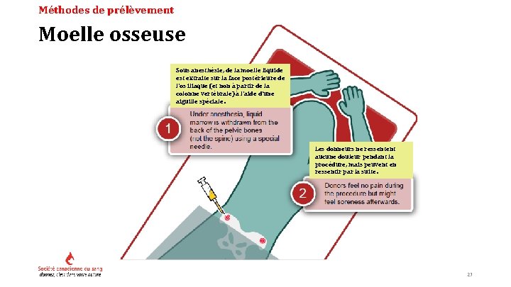 Méthodes de prélèvement Moelle osseuse Sous anesthésie, de la moelle liquide est extraite sur