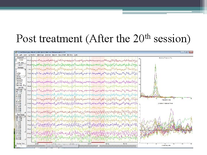 Post treatment (After the 20 th session) 
