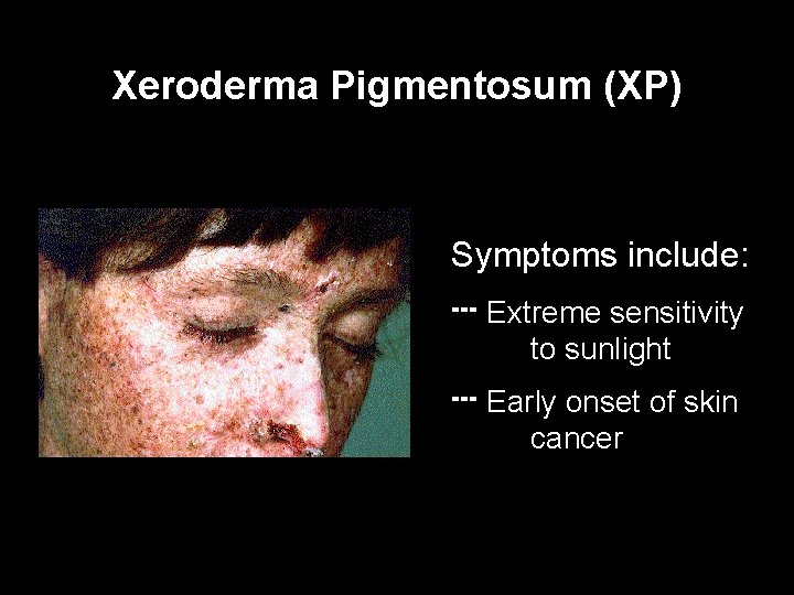 Xeroderma Pigmentosum (XP) Symptoms include: --- Extreme sensitivity to sunlight --- Early onset of