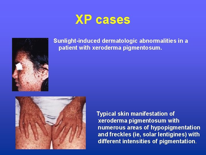 XP cases Sunlight-induced dermatologic abnormalities in a patient with xeroderma pigmentosum. Typical skin manifestation