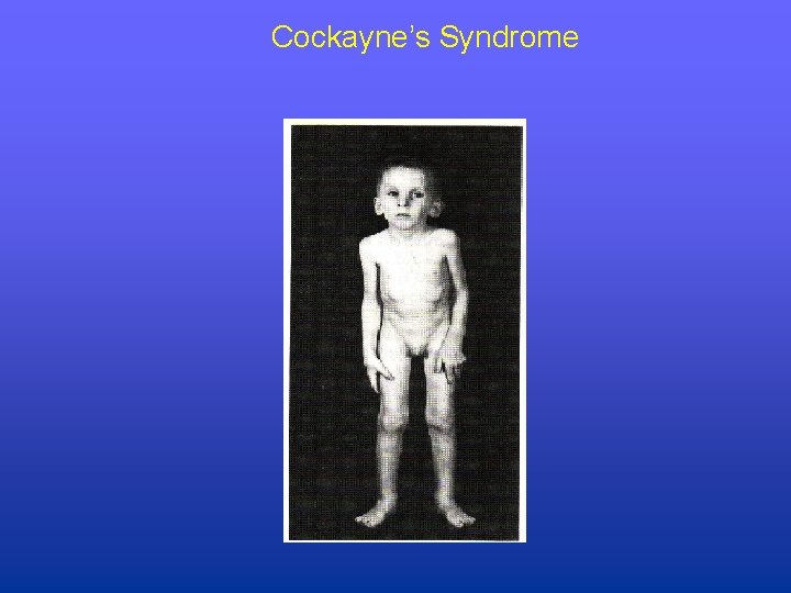 Cockayne’s Syndrome 