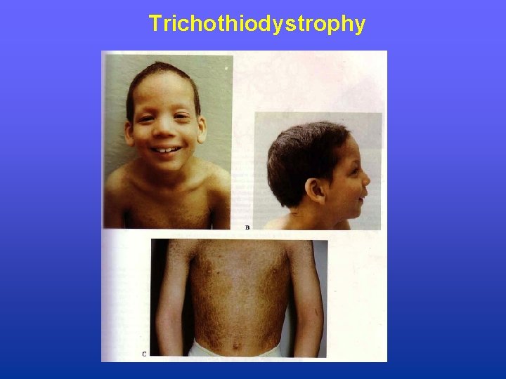 Trichothiodystrophy 