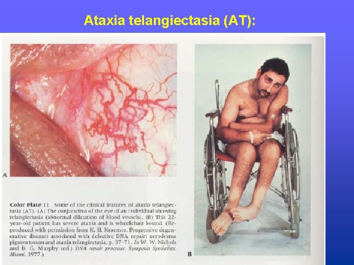 Ataxia telangiectasia (AT): 