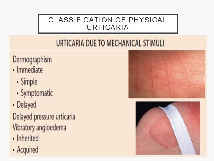 CLASSIFICATION OF PHYSICAL URTICARIA 