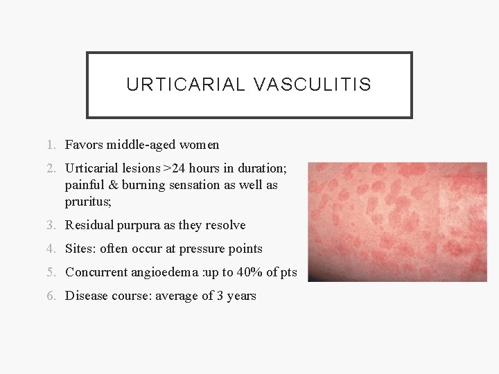 URTICARIAL VASCULITIS 1. Favors middle-aged women 2. Urticarial lesions >24 hours in duration; painful