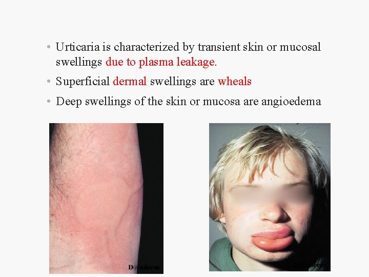  • Urticaria is characterized by transient skin or mucosal swellings due to plasma