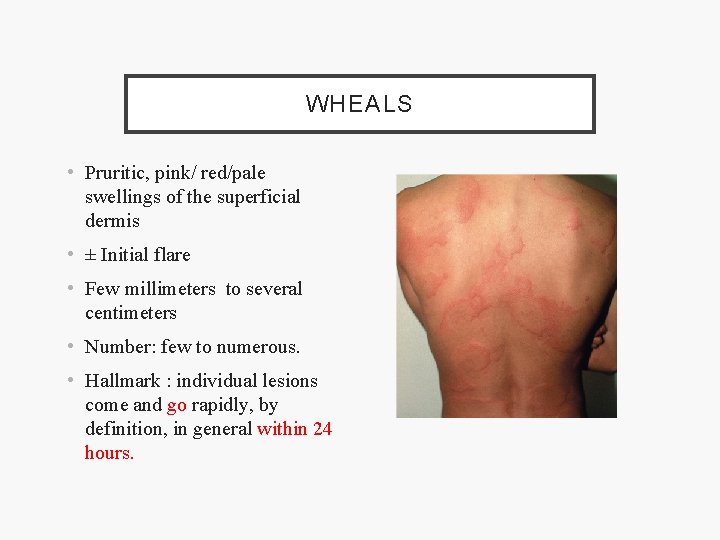 WHEALS • Pruritic, pink/ red/pale swellings of the superficial dermis • ± Initial flare