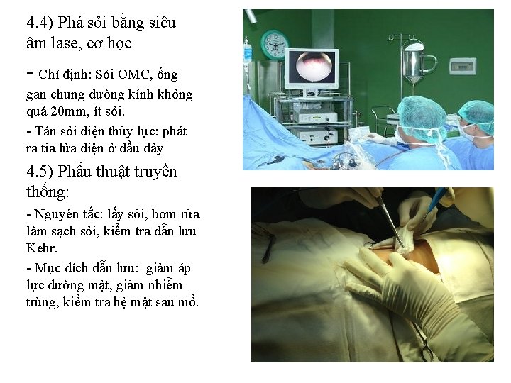 4. 4) Phá sỏi bằng siêu âm lase, cơ học - Chỉ định: Sỏi